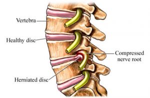 215-back-injuries-herniated-disc