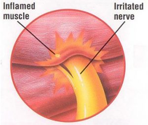 215-inflamed-muscle-and-irritated-nerve